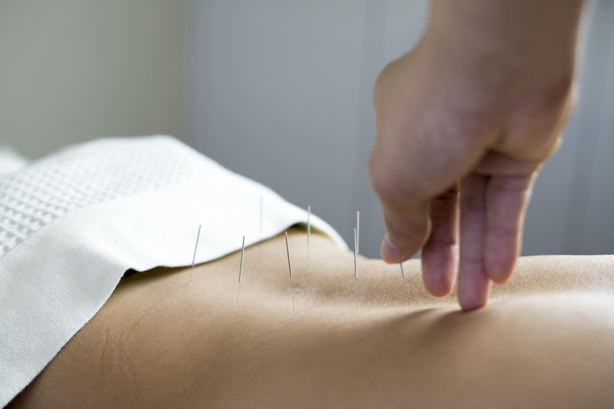 acupuncture needling