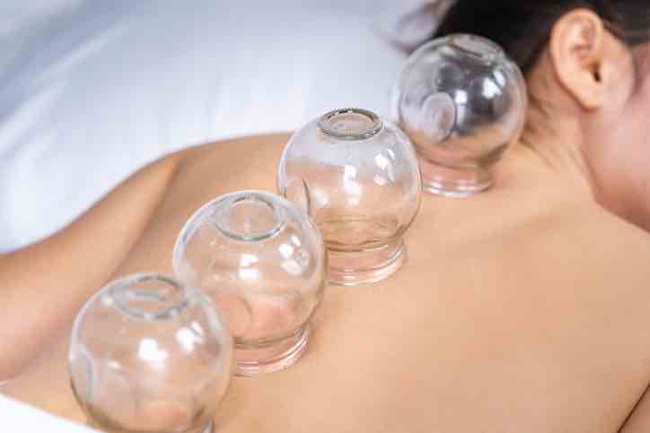 acupuncture cupping