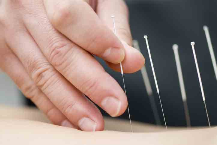 acupuncture needling